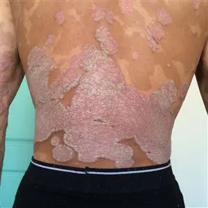 Psoriazės pažeista oda alkūnės srityje