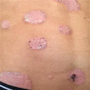 Psoriazės plokštelės ant odos